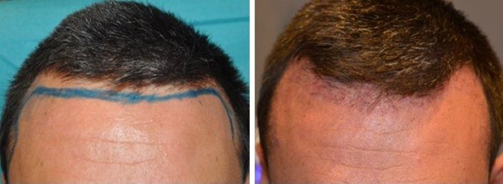 Wimpole Clinic patient before and 1 month after hair transplant