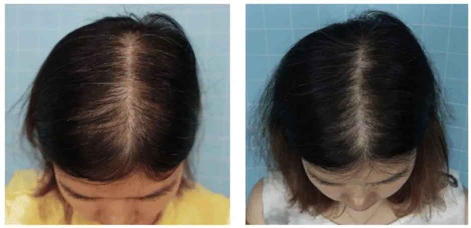 Woman&rsquo;s hair before and after 6 months of daily Minoxidil treatment