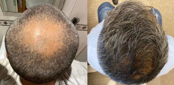 2,500 graft crown hair transplant patient after 15 months