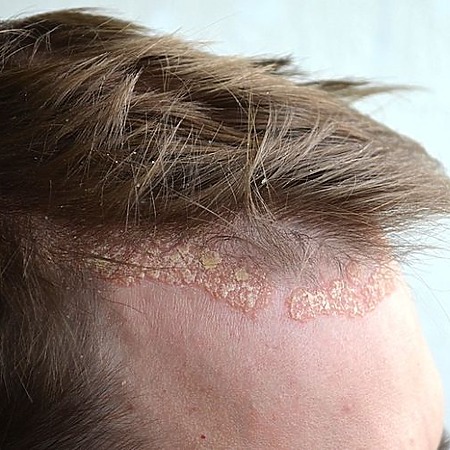 scalp psoriasis on the frontal hairline