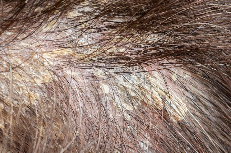 seborrheic dermatitis