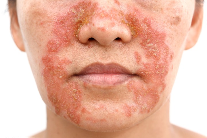 Sebaceous Rash Seborrheic Dermatitis According to the NHS: Causes & Treatments