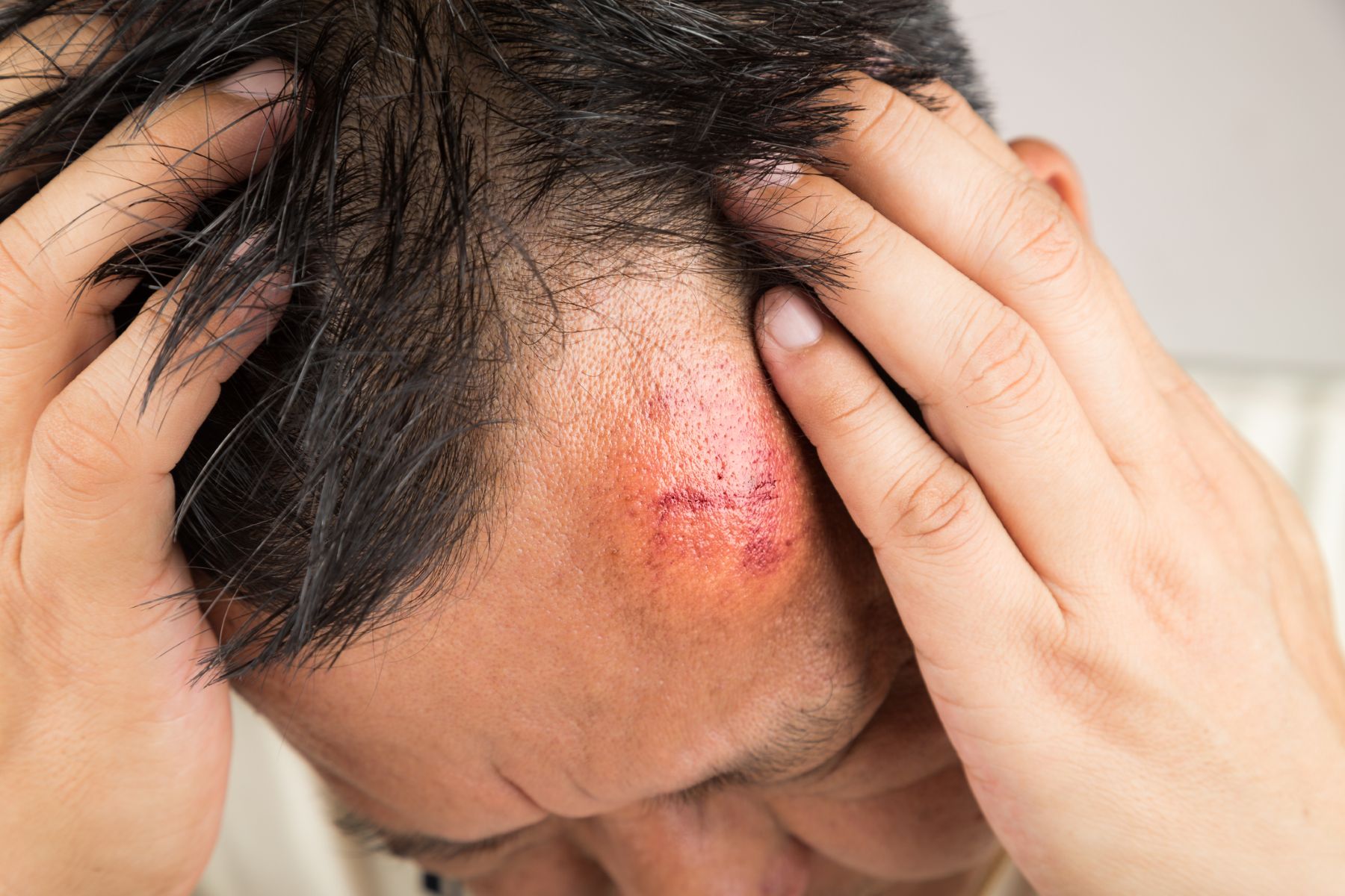 scalp trauma
