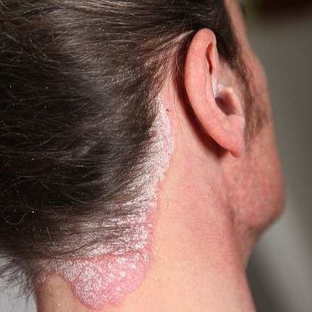 scalp psoriasis behind the ears