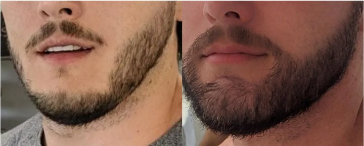 A male patient&rsquo;s beard before and 8 months after a FUE beard transplant