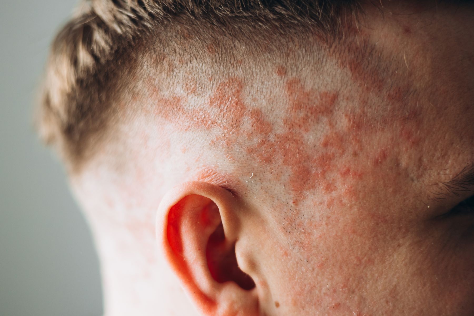 Hair loss from dermatological conditions
