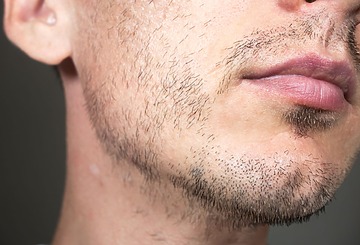 Sparse Beard Gene Map 7 Common Causes Of Patchy Beard Growth