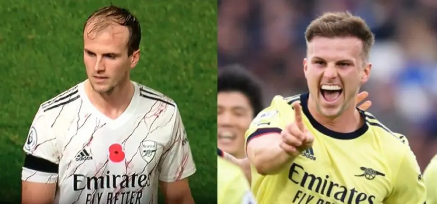 Rob Holding hair transplant