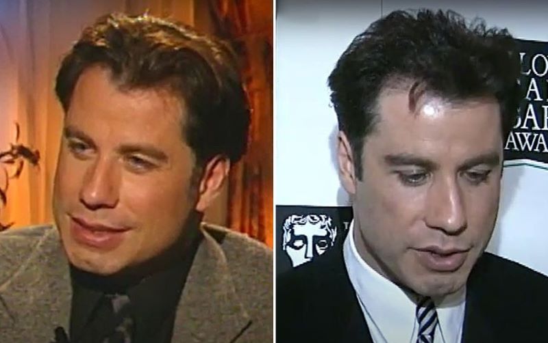 Travolta&rsquo;s first signs of hair loss