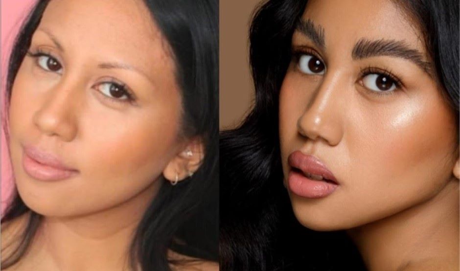 Woman&rsquo;s face before and after eyebrow transplant surgery.