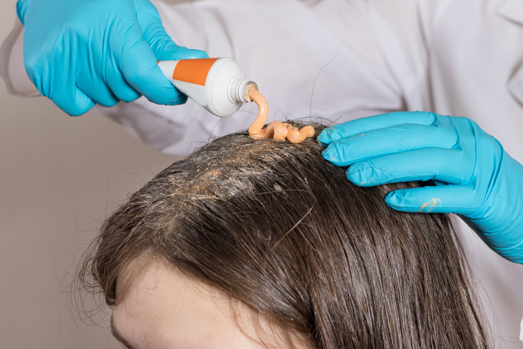 Dermatologist treating patient&rsquo;s scalp problems