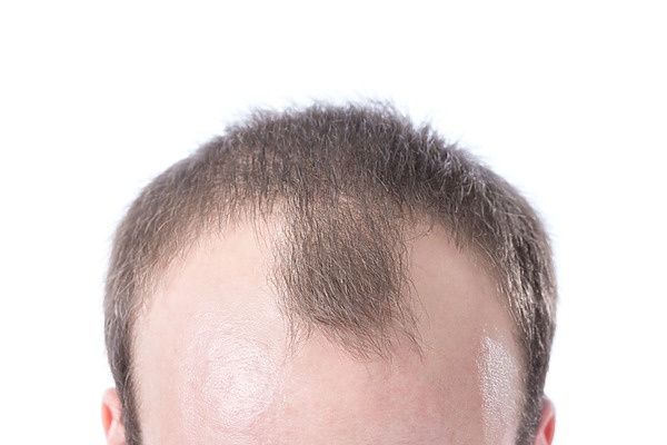 Bad receding hairline