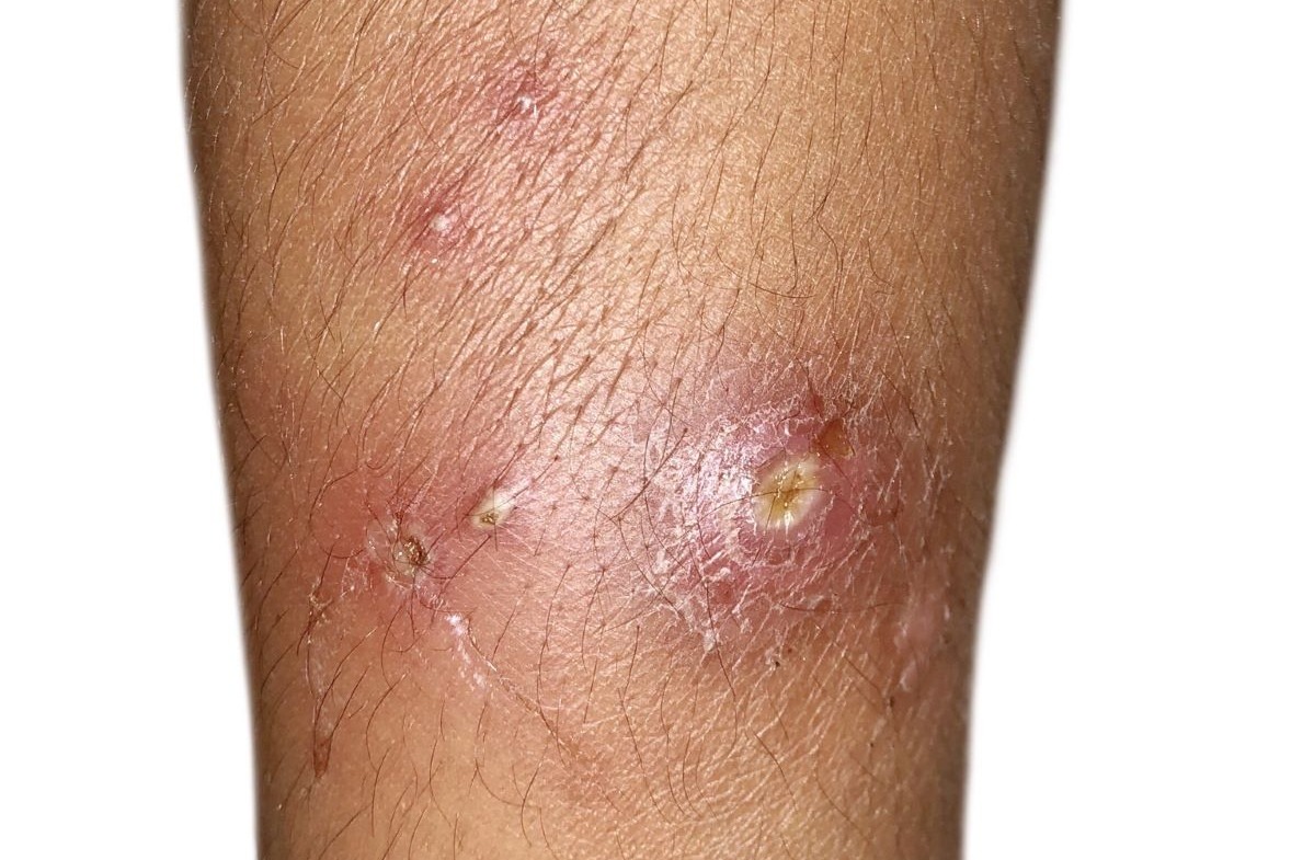 Boils on patient&rsquo;s leg