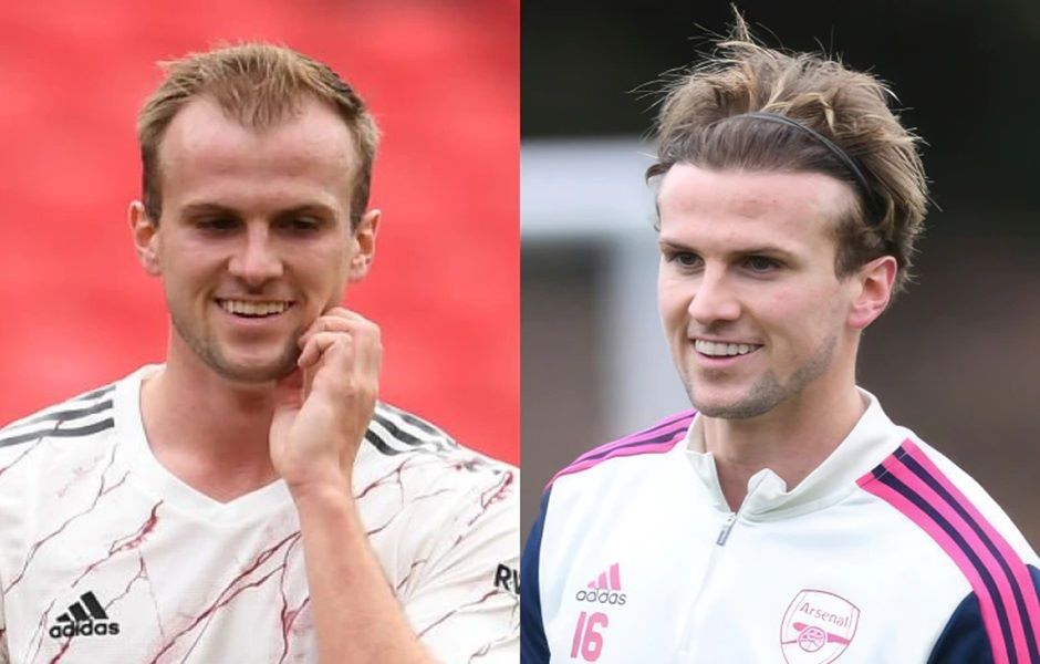 Rob Holding's hair transplant results after 20 months