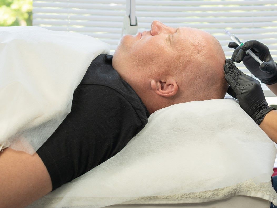 prp hair treatment glasgow