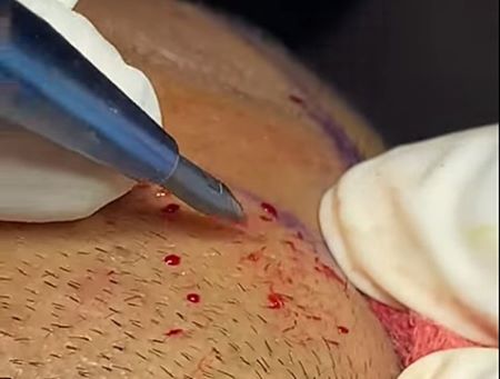 A sapphire hair transplant procedure