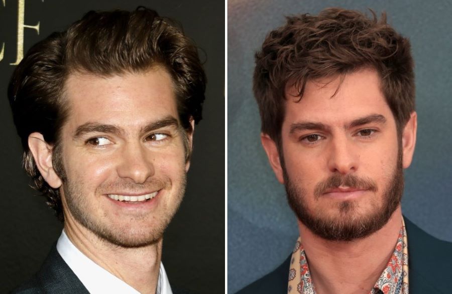 Andrew Garfield&rsquo;s hair transplant before and after