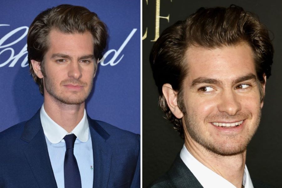 Andrew Garfield&rsquo;s temple hair loss