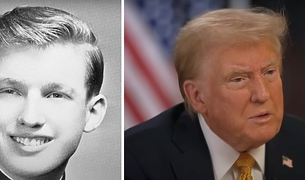 Donald Trump&rsquo;s Hair: Did He Have A Hair Transplant?
