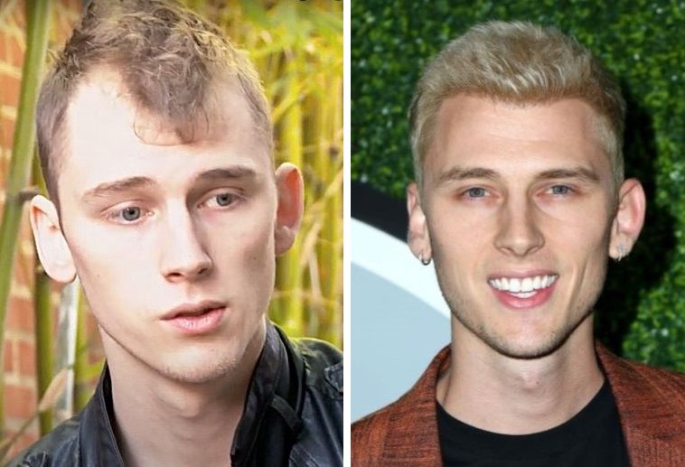 machine gun kelly hair transplant