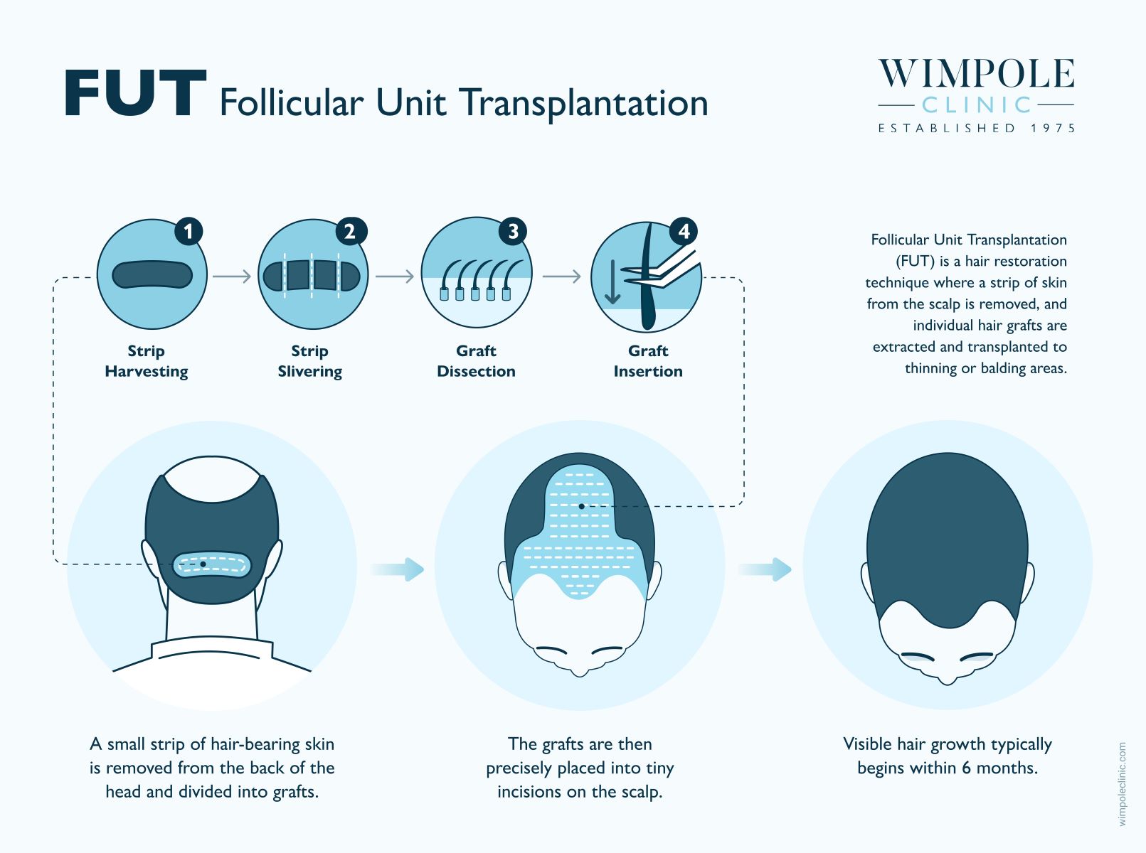 FUT Follicular Unit Transplant
