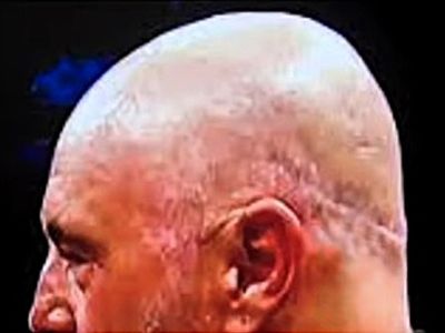 Joe Rogan&rsquo;s hair transplant scar
