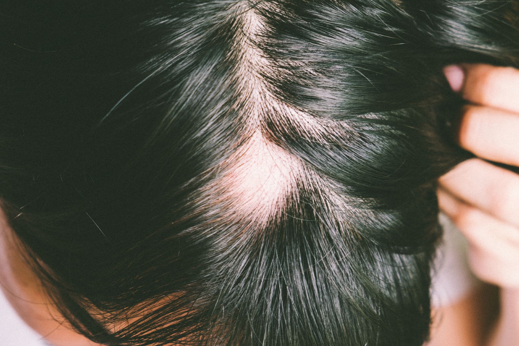 Patchy hair loss from alopecia areata
