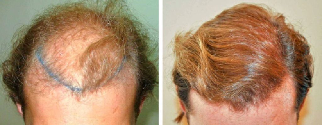 3000 grafts hair transplant
