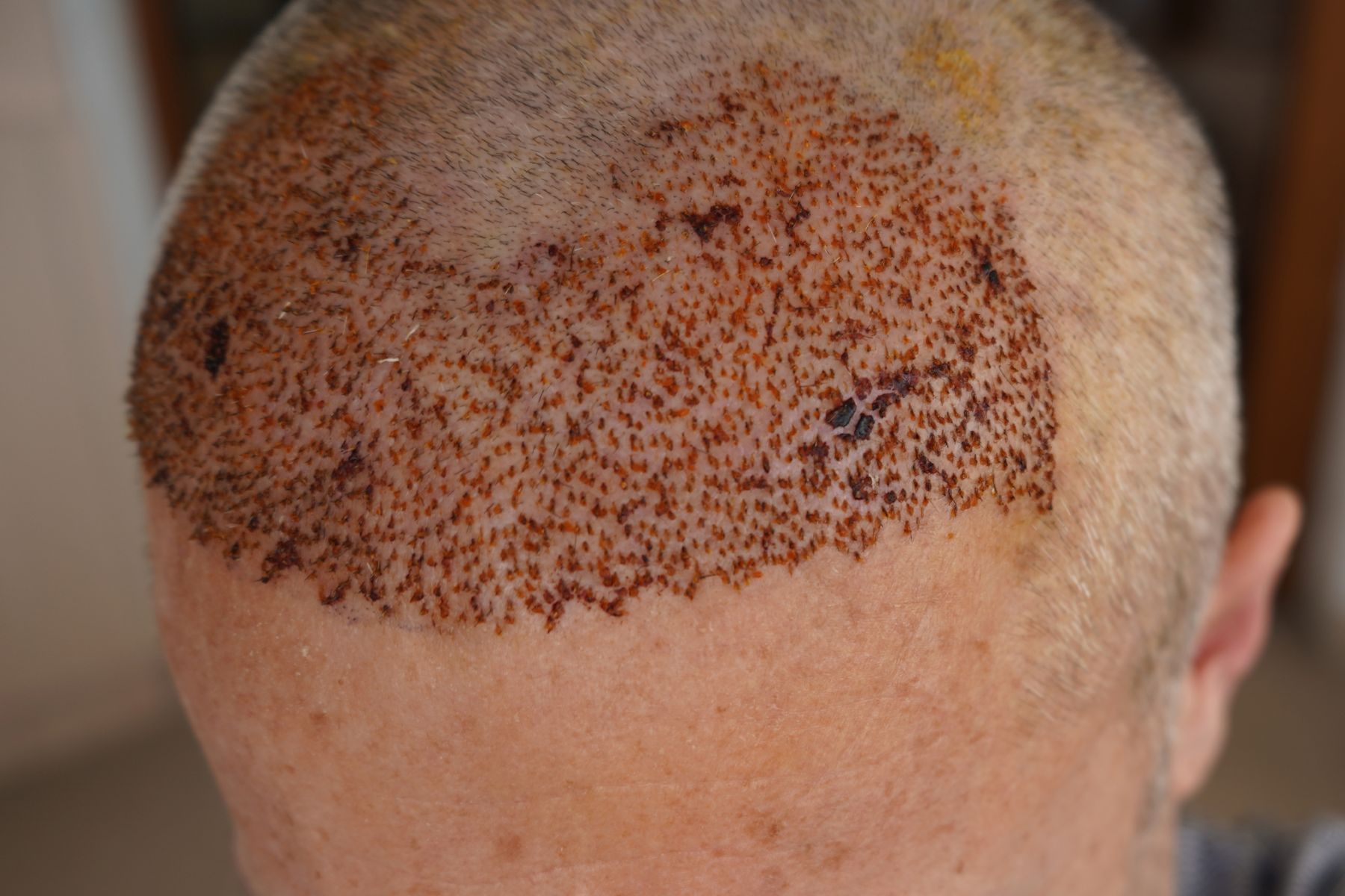Patient in the first days after hair transplant