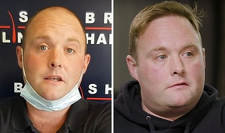Peter Dale &ldquo;Tubes&rdquo; Hair Transplant - All You Need To Know