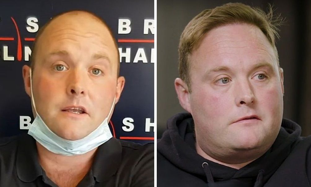 Peter Dale &ldquo;Tubes&rdquo; Hair Transplant - All you need to know