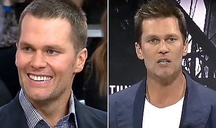 Tom Brady&rsquo;s Hair Transplant: Did It Really Happen?