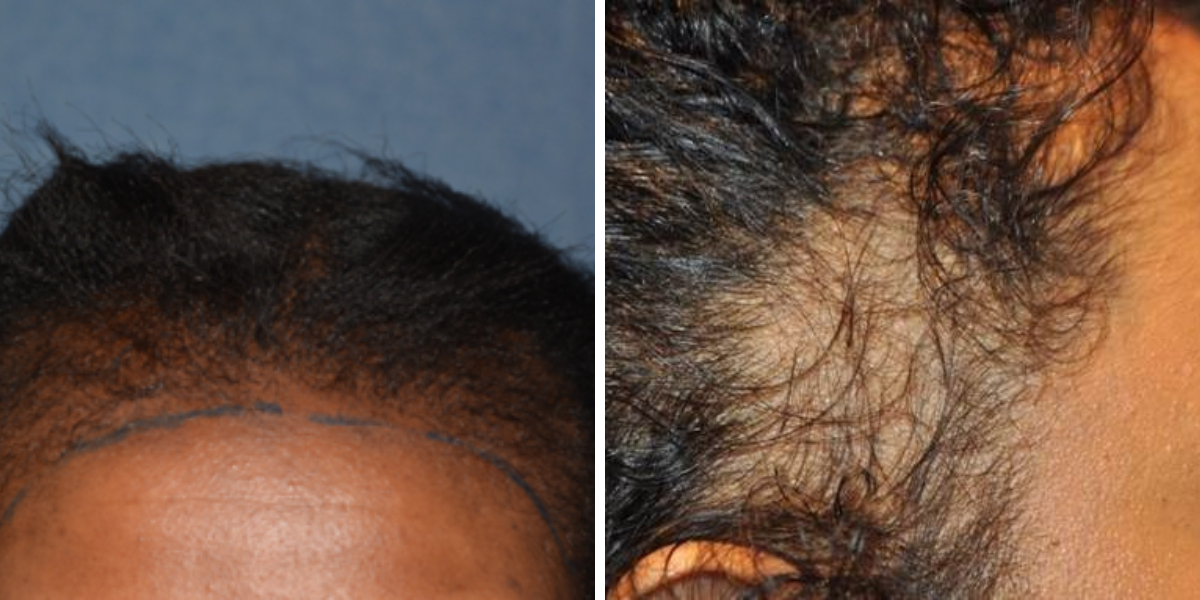 Why Is My Hair Falling Out? A Guide to Hair Loss Diagnosis, Wimpole Clinic