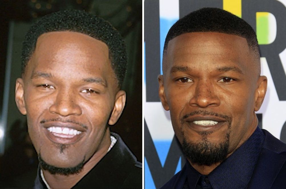 Jamie Foxx hair transplant
