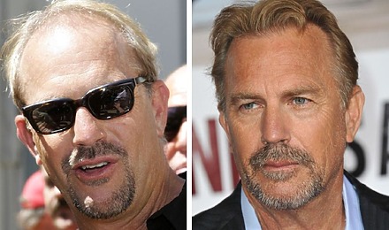 Kevin Costner&rsquo;s Hair Transplant: Everything You Need To Know
