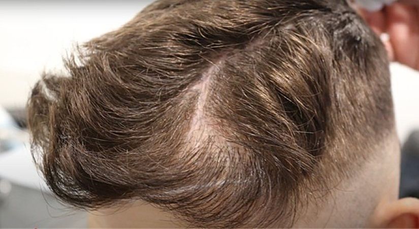 Jake Quickenden&rsquo;s scalp scar