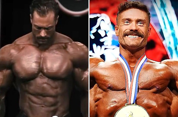 Chris Bumstead&rsquo;s Hair Transplant - The Full Scoop