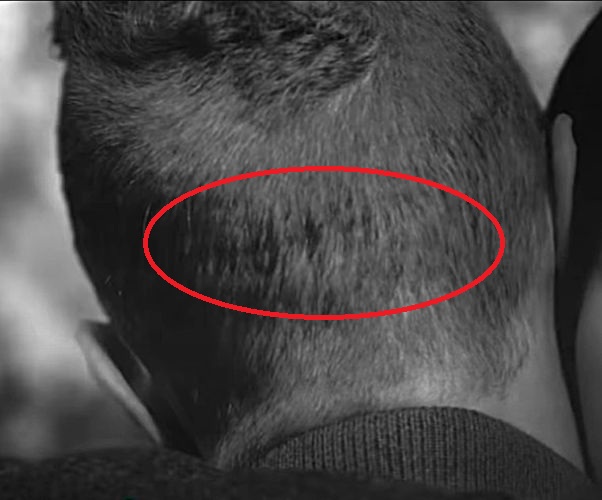 Chris Martin&rsquo;s FUT scar
