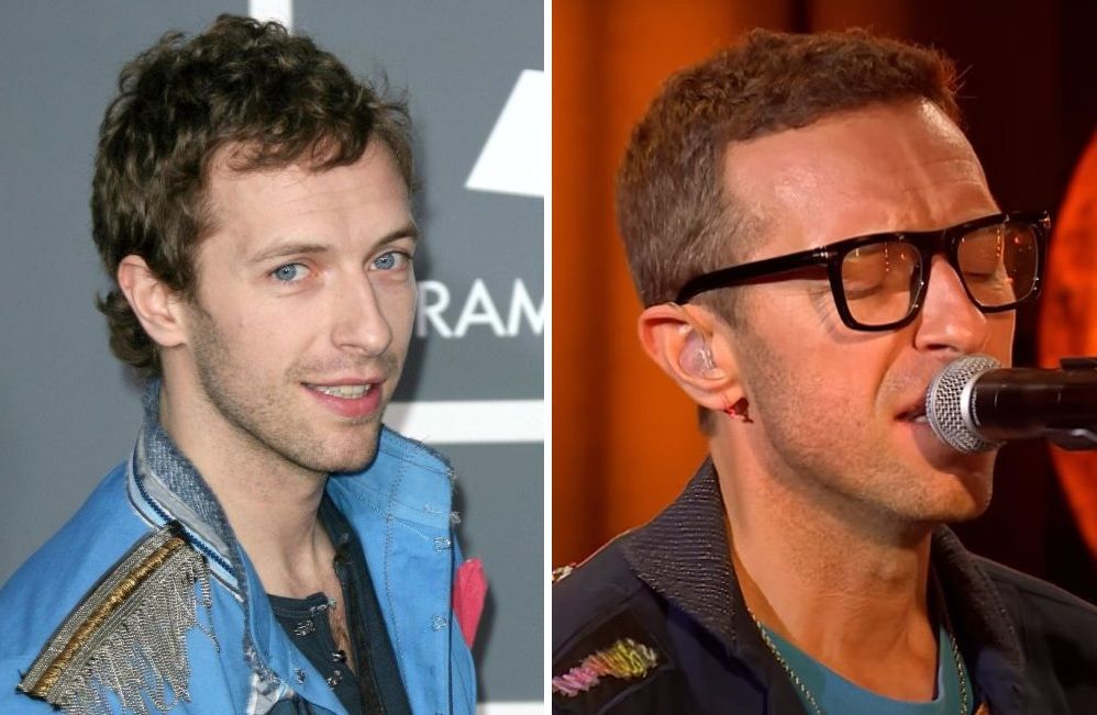 Chris Martin&rsquo;s Hair Transplant: Are the Rumours True?