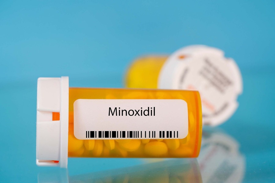 Is Oral Minoxidil Safe For Long-Term Use Against Hair Loss?