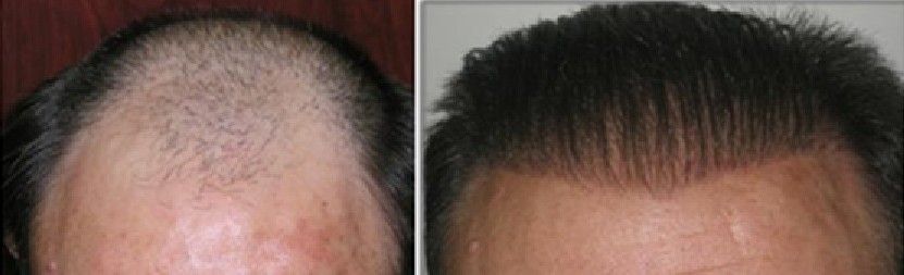 Male patient before and after 4000 Biofibre hair transplant