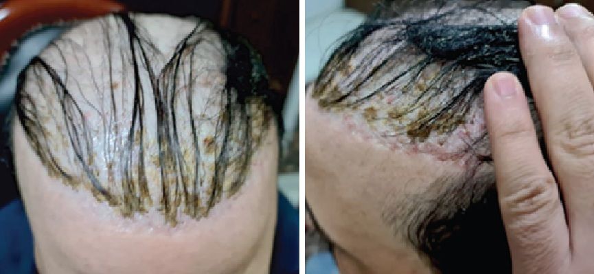 Patient who developed sebum plugs after a poorly cared-for biocompatible fibre hair transplant