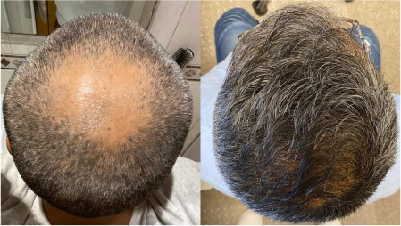 crown hair transplant surgery