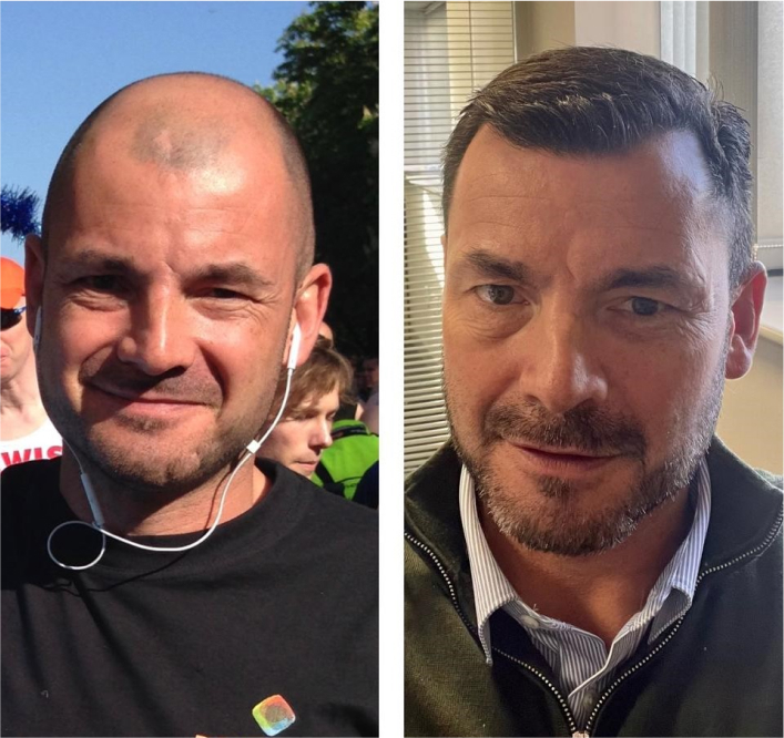 before and after male hair transplant surgery