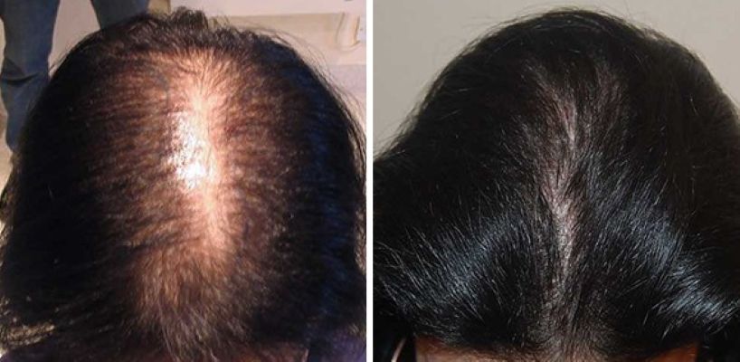 Female patient before and 12 months after her 1500-graft FUT hair transplant