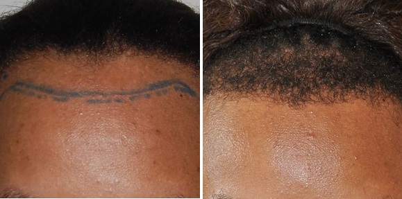 Female patient before and 7 months after her 1500-graft FUT hair transplant