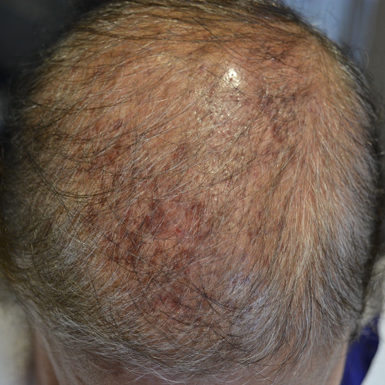 patient with follicultis after hair transplant surgery