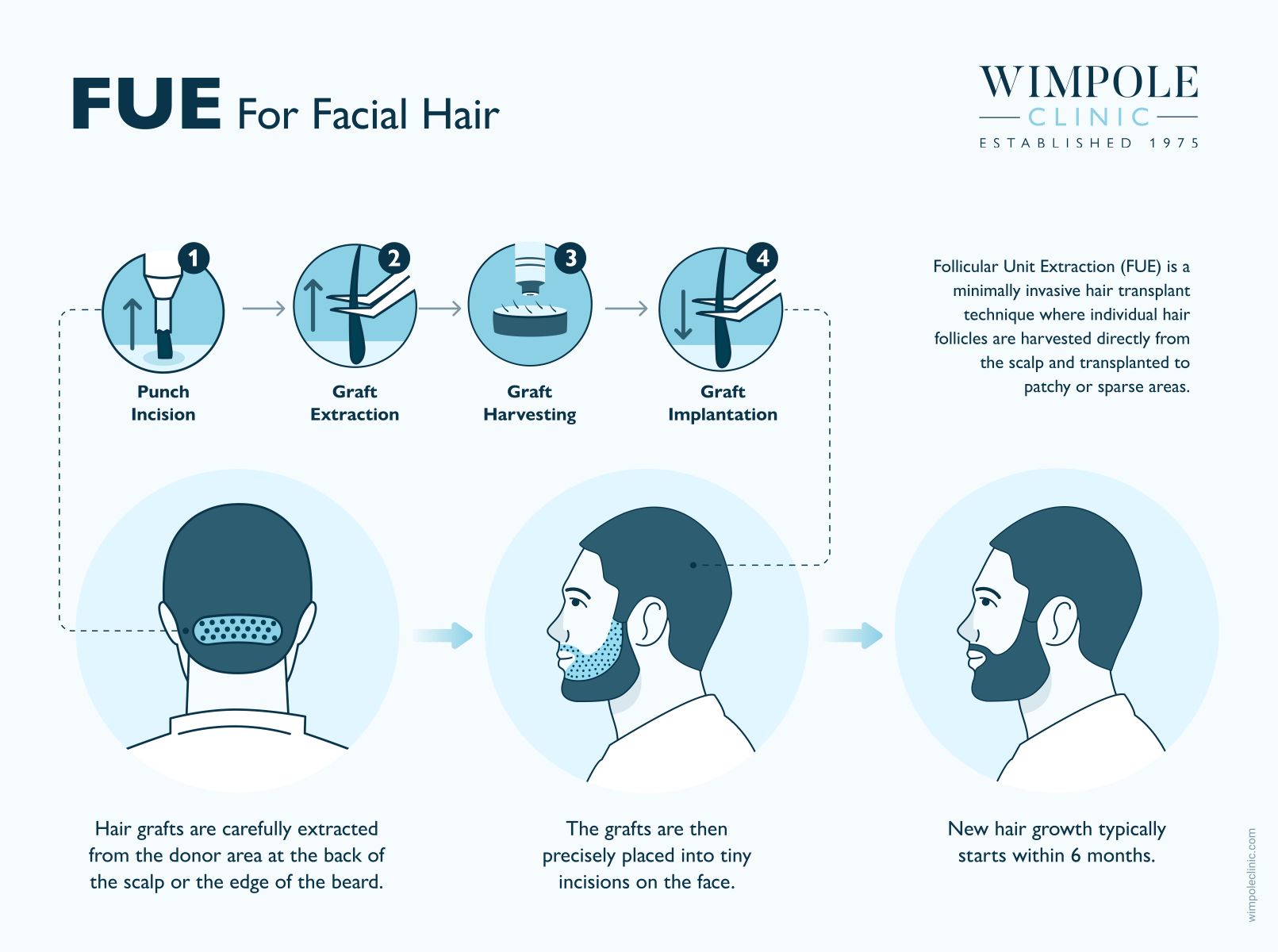 FUE For Facial Hair