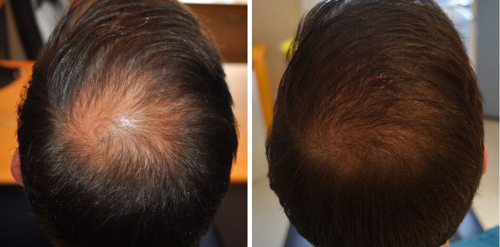 Patient&rsquo;s crown before and 6 months after 2000 graft FUE hair transplant