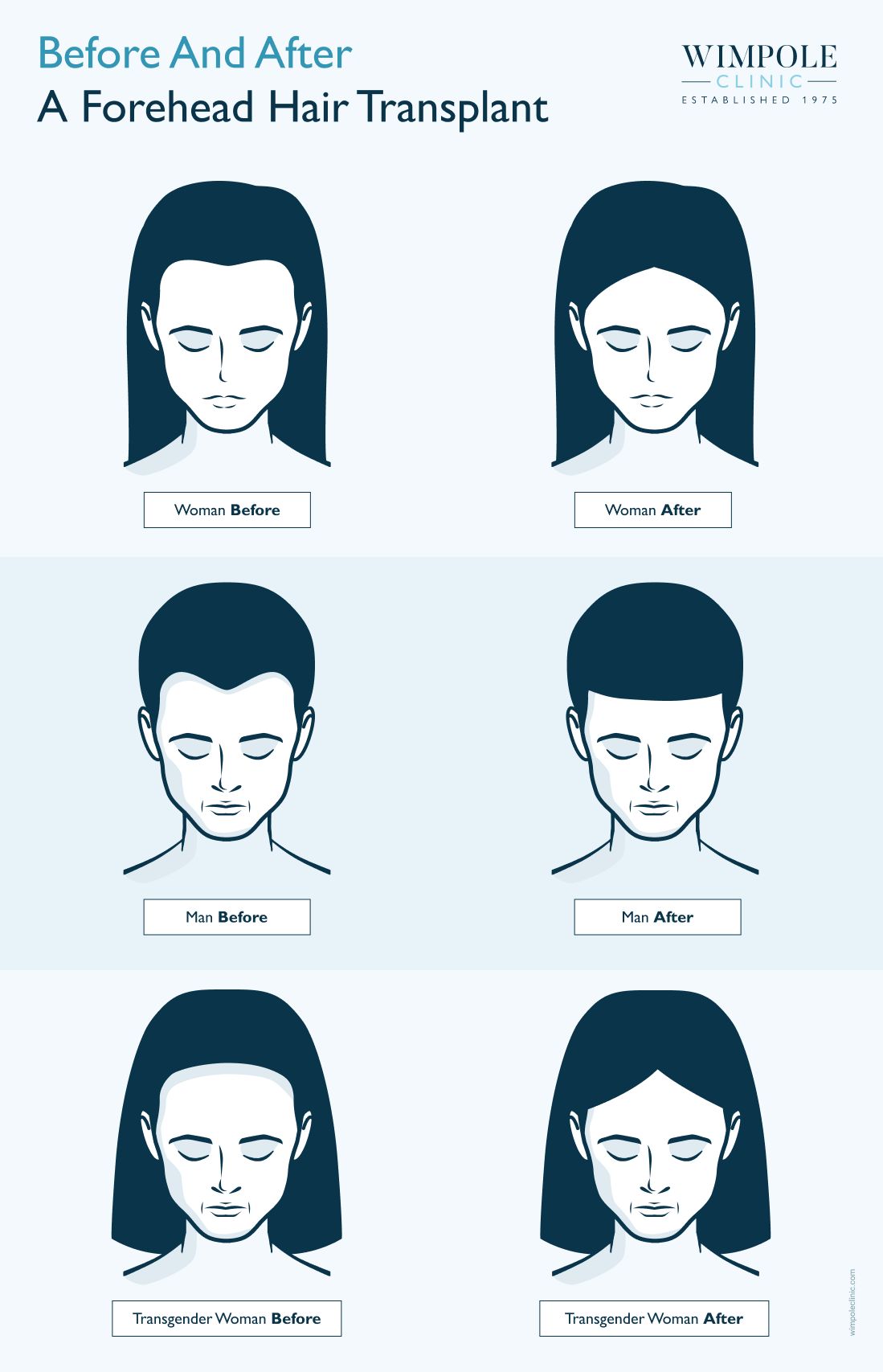 Before and after a forehead hair transplant